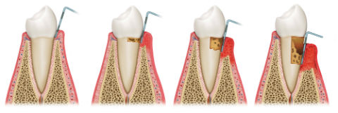 Gum Disease Therapy | River Pointe Dental | Dentist Conroe, TX